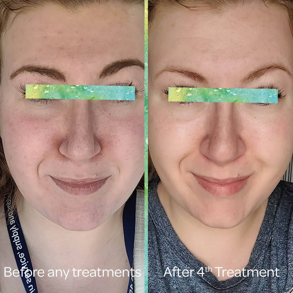 Bio Re Peel Before And After A first time experience of BioRePeel - BF Mulholland Ltd